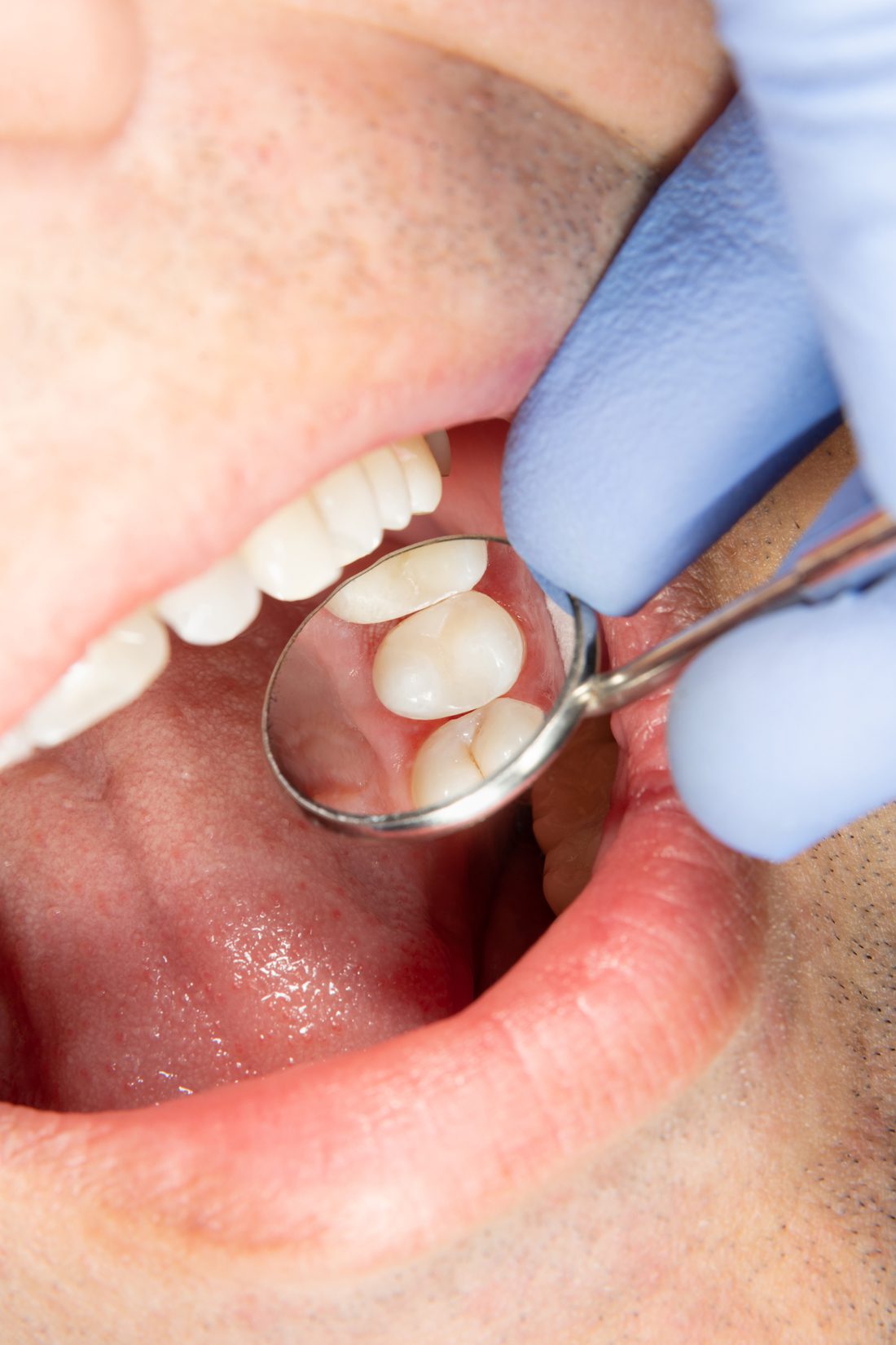 woman smiling with healthy teeth